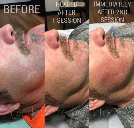 SCAR CORRECTION, SCAR CONCEAL, SCAR CAMOUFLAGE, STRETCH MARK, STRETCH MARKS, MICRO NEEDLING, MICRODERMABRASION, CORRECTIVE TATTOOING, TATTOO, TATTOOS, ADDISON, EDGE, ADDISON EDGE, COSMETIC TATTOO, ADDISON EDGE COSMETICS, ADDISON EDGE TATTOOS, PMU, PERMANENT MAKEUP, EVANSVILLE, INDIANA