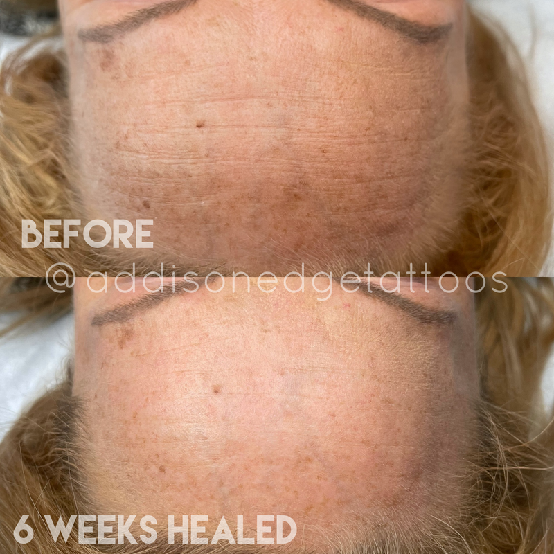 PLASMA, SKIN, TIGHTENING, PLASMA SKIN TIGHTENING, FIBROBLAST, FIBROBLAST SKIN TIGHTENING, PST, PLASMA PEN, LIFT, TREATMENT, NON SURGICAL, NON-SURGICAL, SKINCARE, FACELIFT, DERMA PRO, EYE LIFT, DERMAPRO INTERNATIONAL, CERTIFIED, BROW LIFT, EYEBROW LIFT, BELLY BUTTON, COSMETIC, TATTOO, TATTOOS, PMU, PERMANENT MAKEUP, ADDISON, EDGE, ADDISON EDGE, COSMETIC TATTOO, ADDISON EDGE COSMETICS, ADDISON EDGE TATTOOS, PMU, PERMANENT MAKEUP, EVANSVILLE, INDIANA, EVANSVILLE MICROBLADING, MICROBLADING EVANSVILLE, E IS FOR EVERYONE, EVV, WE ARE EVV