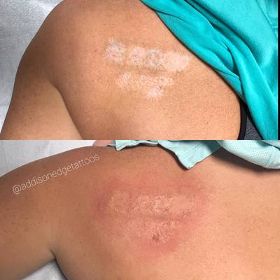 SCAR CORRECTION, SCAR CONCEAL, SCAR CAMOUFLAGE, STRETCH MARK, STRETCH MARKS, MICRO NEEDLING, MICRODERMABRASION, CORRECTIVE TATTOOING, TATTOO, TATTOOS, ADDISON, EDGE, ADDISON EDGE, COSMETIC TATTOO, ADDISON EDGE COSMETICS, ADDISON EDGE TATTOOS, PMU, PERMANENT MAKEUP, EVANSVILLE, INDIANA
