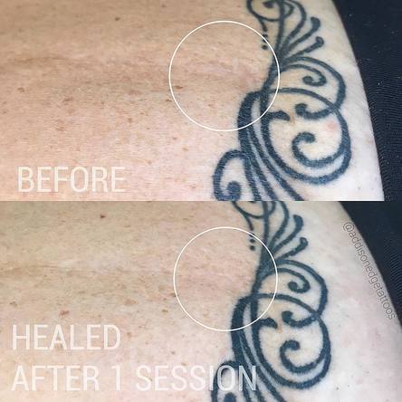 SCAR CORRECTION, SCAR CONCEAL, SCAR CAMOUFLAGE, STRETCH MARK, STRETCH MARKS, MICRO NEEDLING, MICRODERMABRASION, CORRECTIVE TATTOOING, TATTOO, TATTOOS, ADDISON, EDGE, ADDISON EDGE, COSMETIC TATTOO, ADDISON EDGE COSMETICS, ADDISON EDGE TATTOOS, PMU, PERMANENT MAKEUP, EVANSVILLE, INDIANA